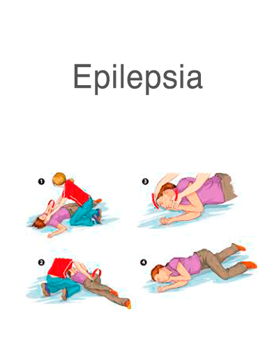 epilepsiav2.png